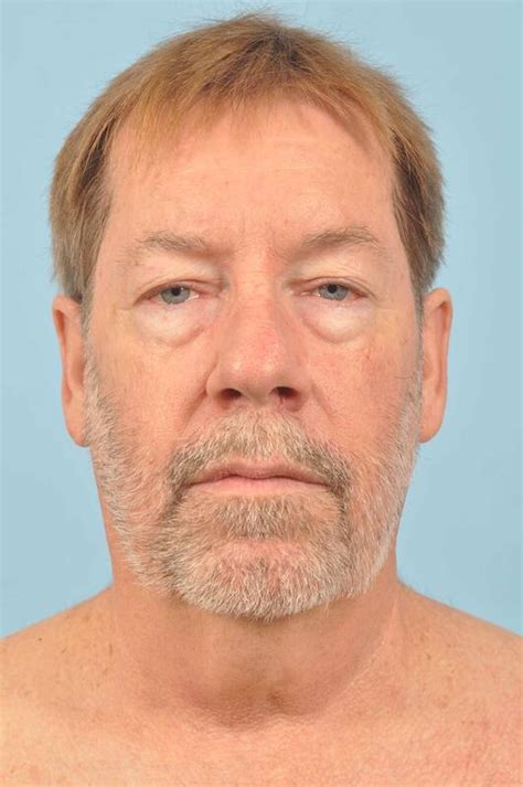 mid face lift before & after