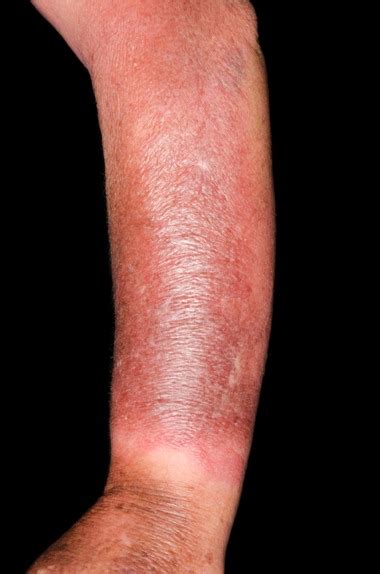 NHS 111 Wales - Health A-Z : Cellulitis