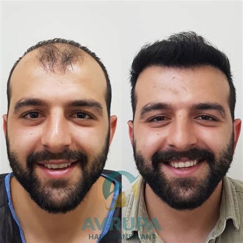 how much does it cost for hair transplant in turkey 2