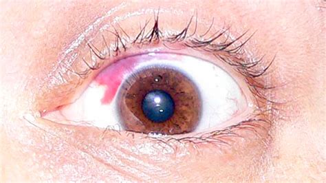 What You Need to Know If You Have a Red Spot on Your Eye