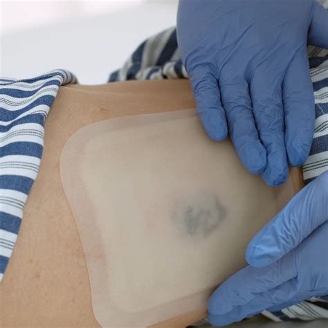 how often to change hydrocolloid dressing