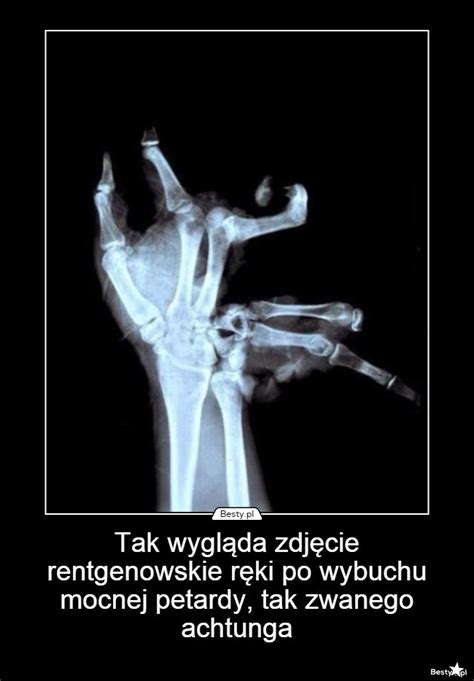 BESTY.pl - Tak wygląda zdjęcie rentgenowskie ręki po wybuchu mocnej ...