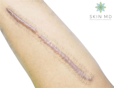 Want a Scar-Free Skin? Discover the Best Scar Treatment Options for You ...