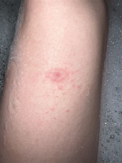 Does this look like Lyme? : r/Lyme