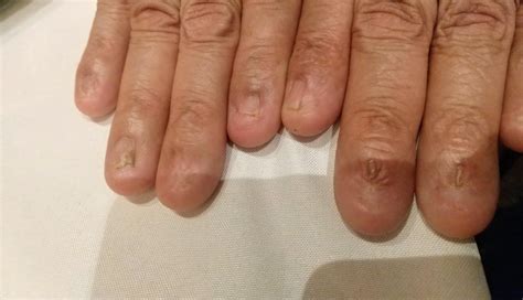 Finger Without Nail