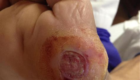Diabetic Ulcer - MD Searchlight