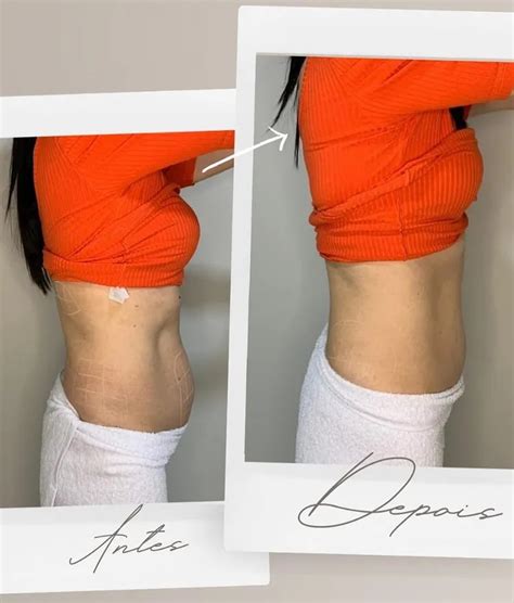 Hidrolipo Flancos Antes E Depois - Hidrolipo: Antes e depois – Antes da Fama