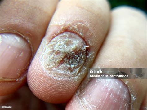 close  besar infeksi jamur  kuku tangan jari  onychomycosis