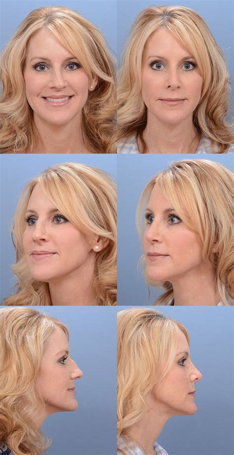 Rhinoplasty Recovery