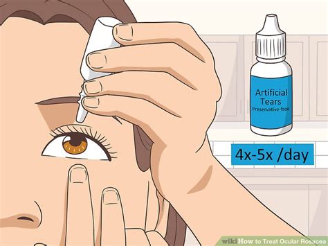 How to Treat Ocular Rosacea: 14 Steps (with Pictures) - wikiHow