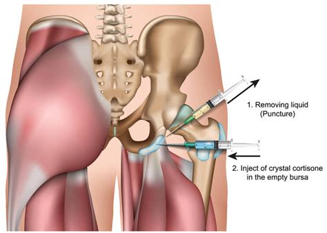 Knee bursitis Free Stock Vectors