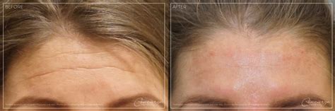 Before and After Photos - Botox and Juvederm | Concierge Aesthetics