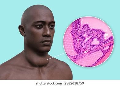 3d Illustration Man Enlarged Thyroid Gland Stock Illustration 2382618759 | Shutterstock