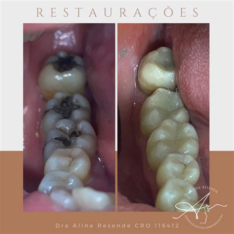 Dor De Dente Após Restauração Com Resina - Restauração em resina ou amálgama? - Clínica Aline Resende