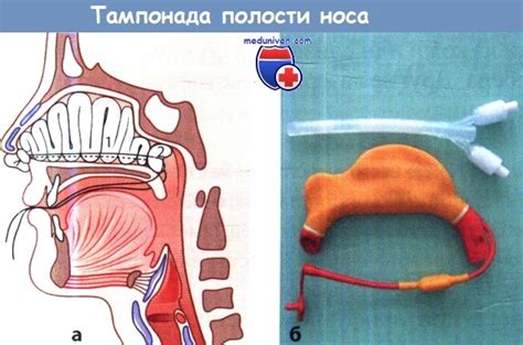 Повреждения носа и их лечение. Носовое кровотечение