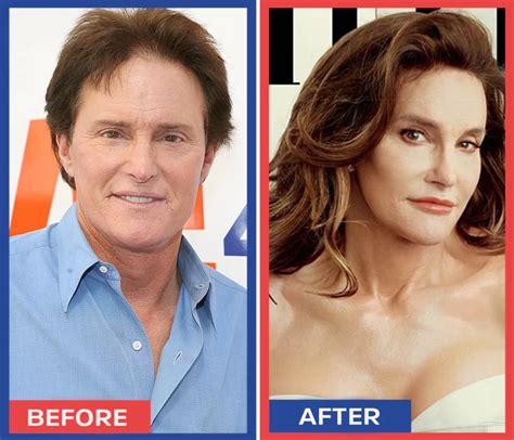 Caitlyn Jenner Plastic Surgery - Milano Klinik