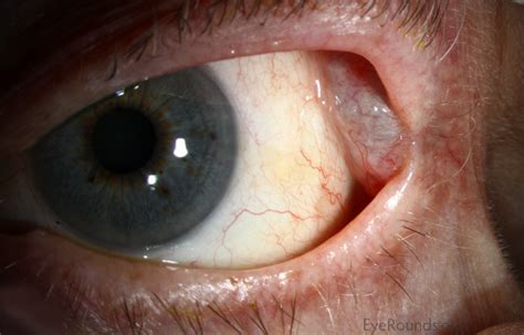 lacrimal cyst tear duct disorders griffin eye socket disorders