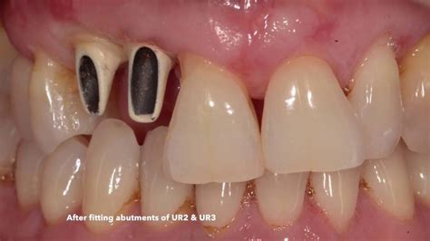 Lateral Incisor Implant