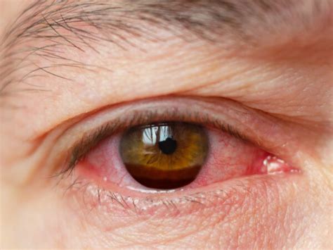 burst blood vessel   eye  treatment  recovery