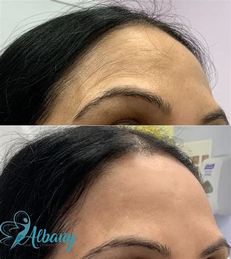 forehead botox case   albany cosmetic  laser centre edmonton