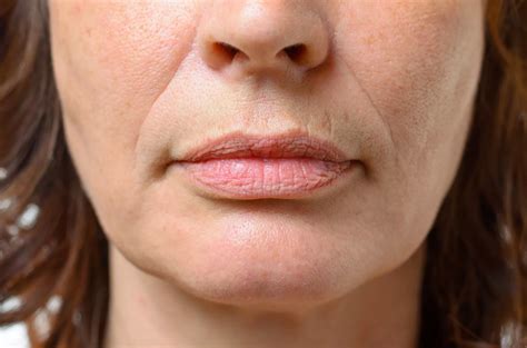 smooth   signs  aging discover nasolabial fold filler