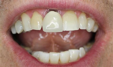 dentist  anderson sc   single anterior crown