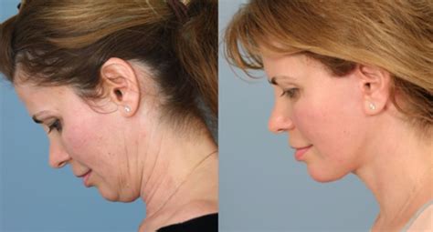 Neck - Facial Cosmetic Surgeon Newport Beach CA