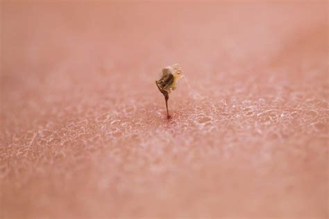 kena sengat lebah  perlu buat  rawatan  diperlukan