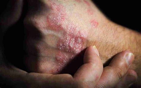 penyakit kusta kenali penyebabnya mandira distra abadi