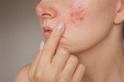 Rosacea and Menopause