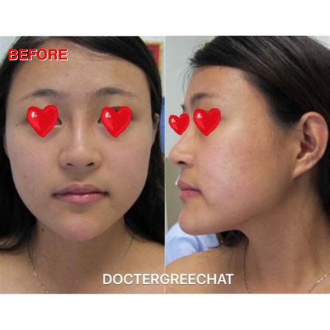 ⭐️ REDUCTION GONIOPLASTY (Mandibular Angle Reduction) + BUCCAL FAT