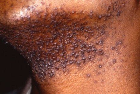 What Causes Razor Burn? [+5 Remedies & Treatments] - Shave.net