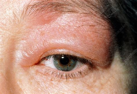 bug bite swollen eyelid treatment fast  victoria gregory blog