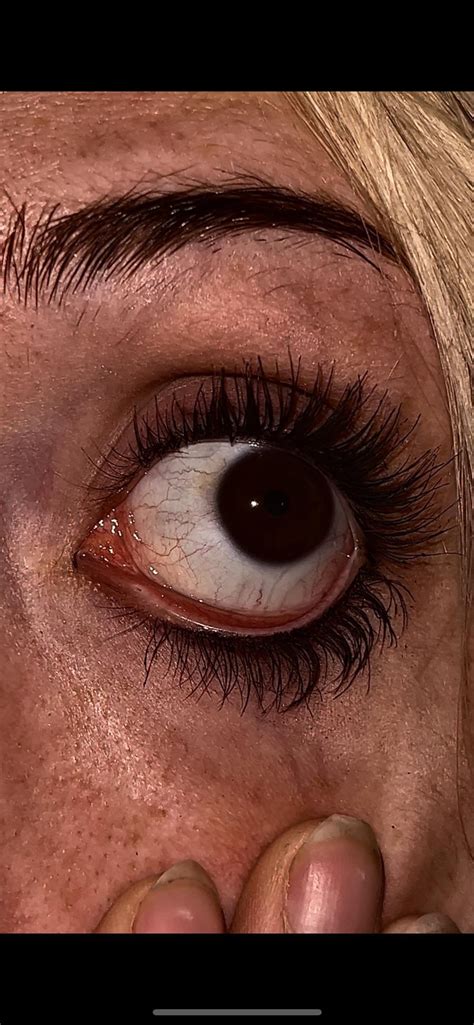 new blood vessels + dark spots forming in both eyes? : r/medical_advice