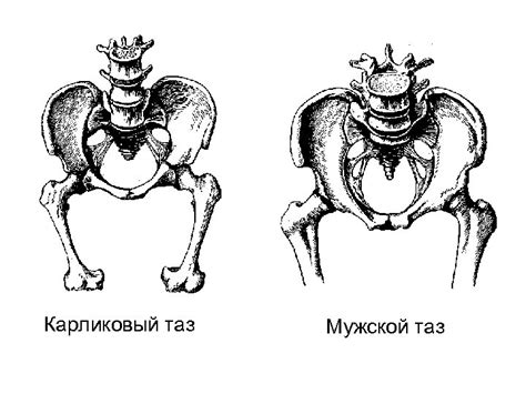 Узкий таз Классификация — Анатомически узкий таз