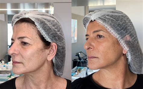 Morpheus Antes E Depois Rosto - Morpheus 8 - Living Clinic