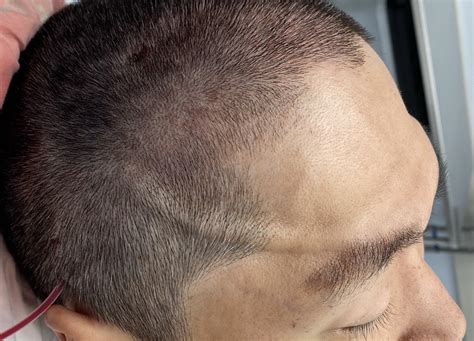 Bumps On Brow Bone at Darcy Bromley blog