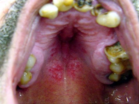 Tipos De Fungos Na Boca - Existe candidíase na boca? - RK Paiva Odontologia