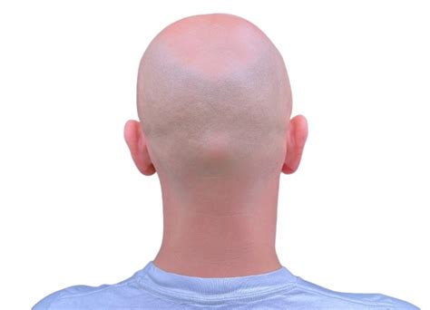 Horseshoe Pattern Baldness