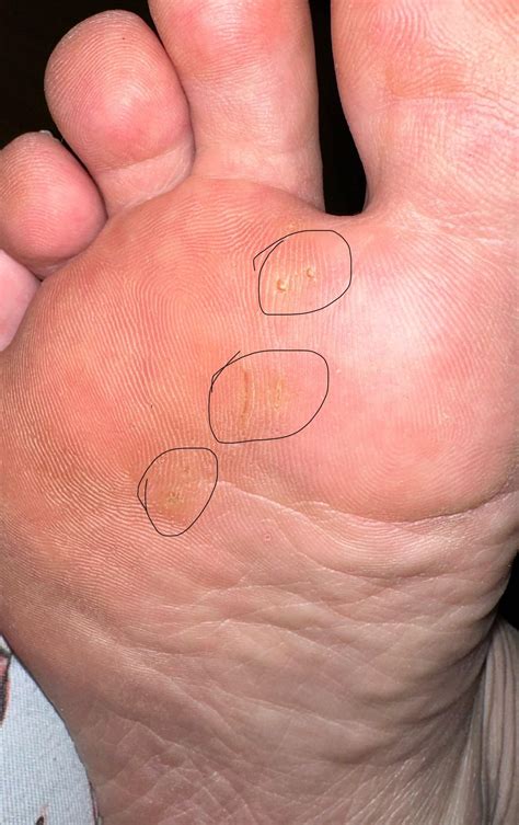 Seed Corns or Plantar Warts? : r/Warts