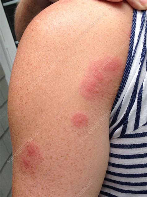 What Does A Bed Bug Bites Look Like at Chris Henry blog