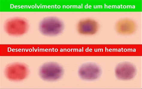 O Que Significa Hematoma - Hematomas: Sintomas, causas e tratamentos | Saúde - TudoPorEmail
