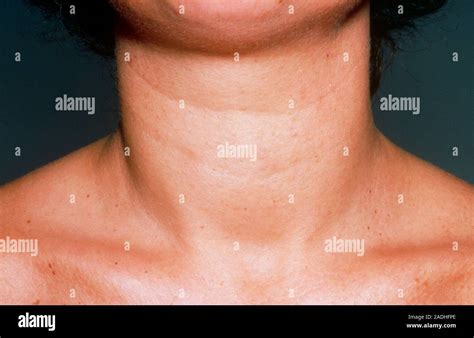 woman  goitre  swelling   neck caused   enlargement
