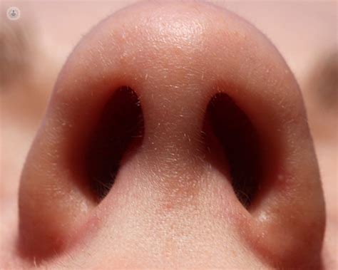 Inflamed Nasal Turbinates