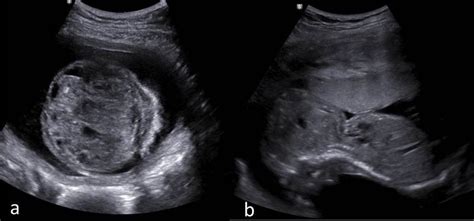 Ultrasound images showing solid-cystic mass extending from anterior ...