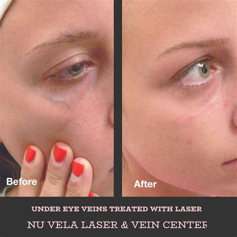 Laser Therapy Facial Veins at Caitlin Gilles blog