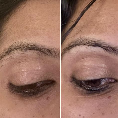 Stubborn milia on eyelid went away : r/CanSkincare