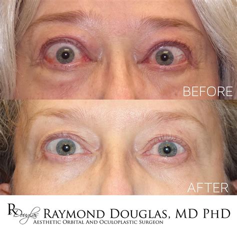 TEPEZZA before & after 👁👁 Week 1 vs week 21 (final infusion). This
