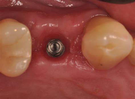 The devil is in the details: case selection for optimal implant