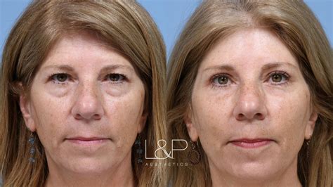 Surgical eye procedure that gives a more youthful and refreshed look.